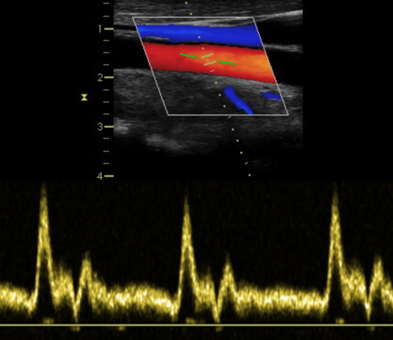 Bild: Gefäßultraschall