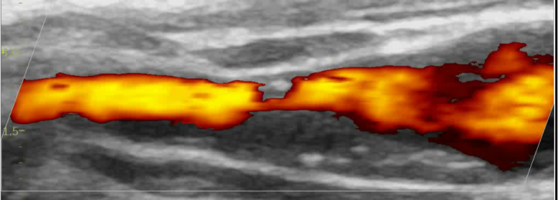 Bild: Gefäßultraschall